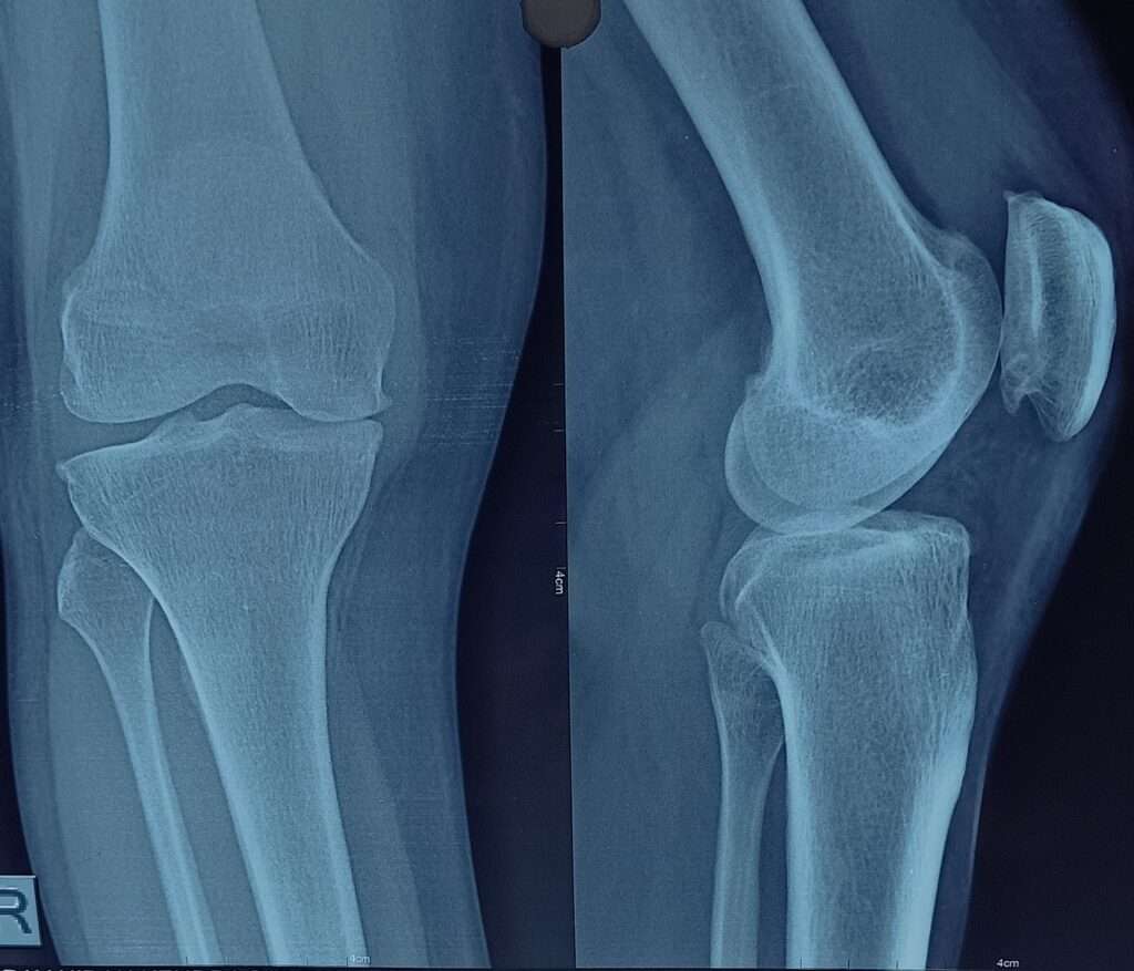 एक्सरे knee joint 